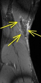 Figure 6 for case Semitendinosus tendon tear, retracted( RID2717 )